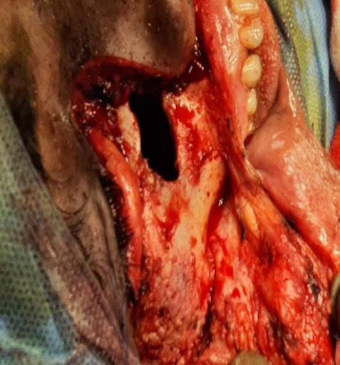 COVID-19-and-Mucormycosis-6