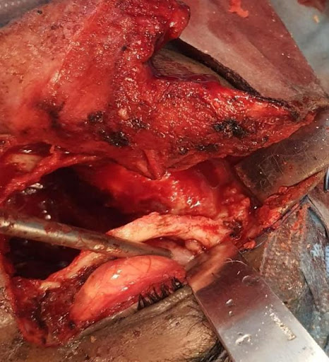 COVID-19-and-Mucormycosis-7