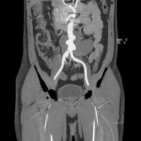 Saccular-Abdominal-Aortic-Aneurysms-1