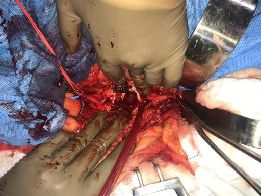 Saccular-Abdominal-Aortic-Aneurysms-2