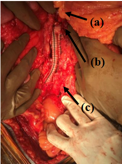 Saccular-Abdominal-Aortic-Aneurysms-3