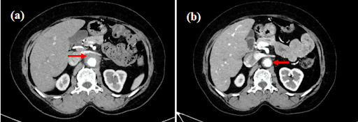 Saccular-Abdominal-Aortic-Aneurysms-4