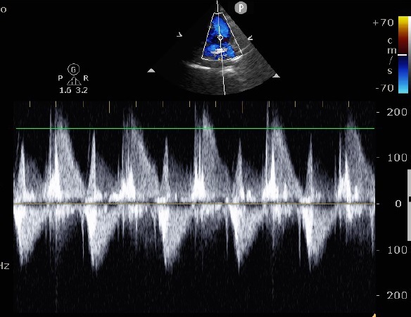 pulmonary-valve-endocarditis-fig-2