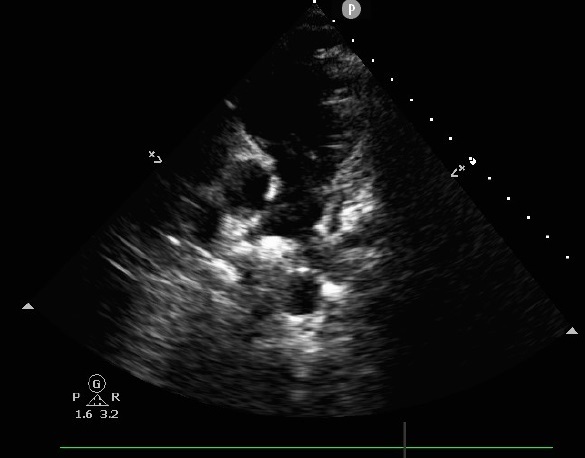 pulmonary-valve-endocarditis-fig-3