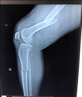 Pre-op x-rays