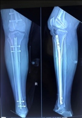 Pre-op x-rays