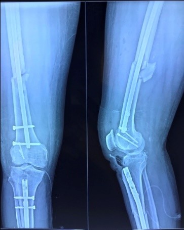 Post-op x-rays