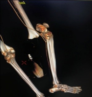 CT Angiogram