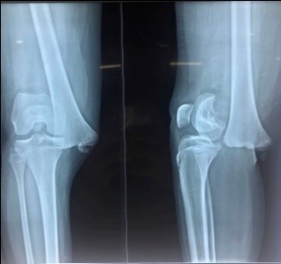 Pre-op x-ray