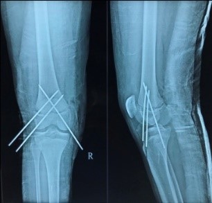 Post-op x-ray