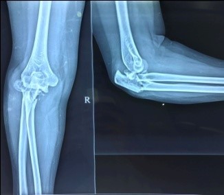 Pre-op x-ray