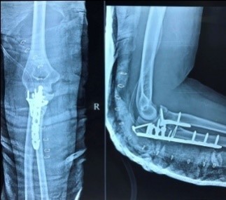 Post-op x-ray