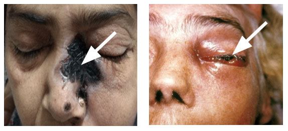 Mucormycosis-7
