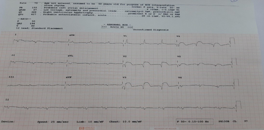 ECG-finding
