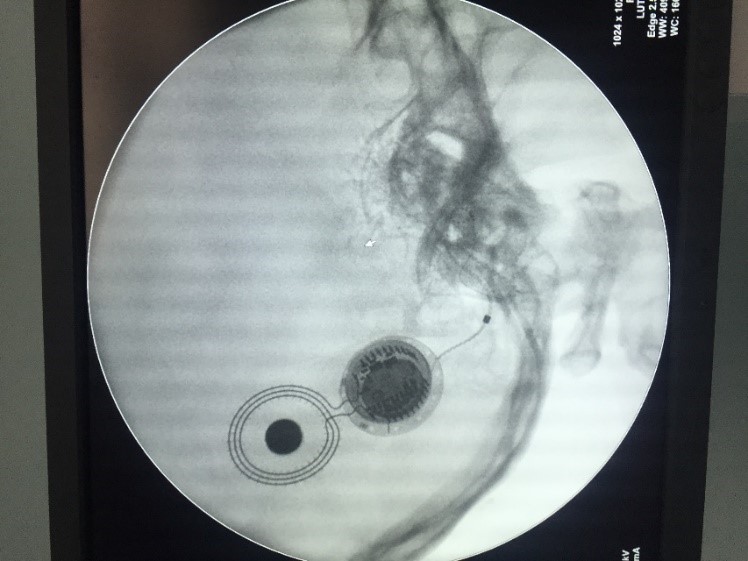 On table C arm X-ray of internal package in situ