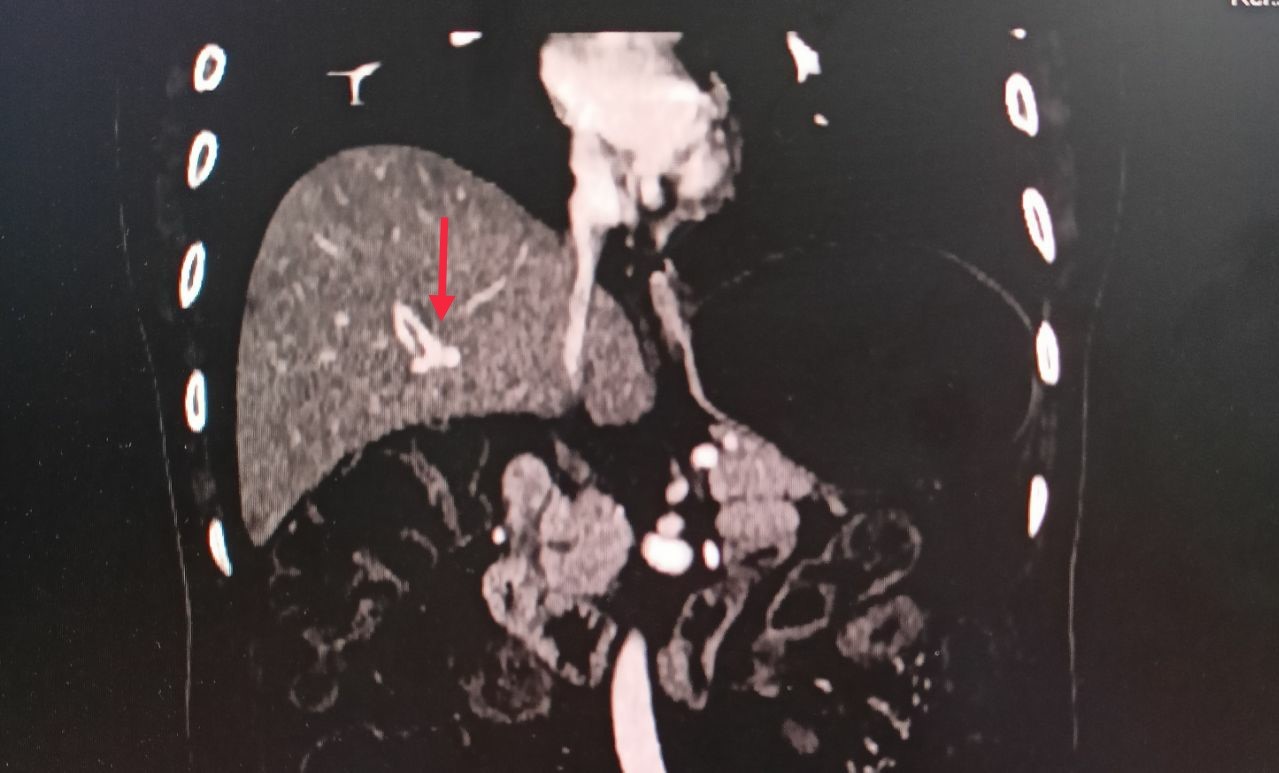 Veno-occlusive-mesenteric-ischemia