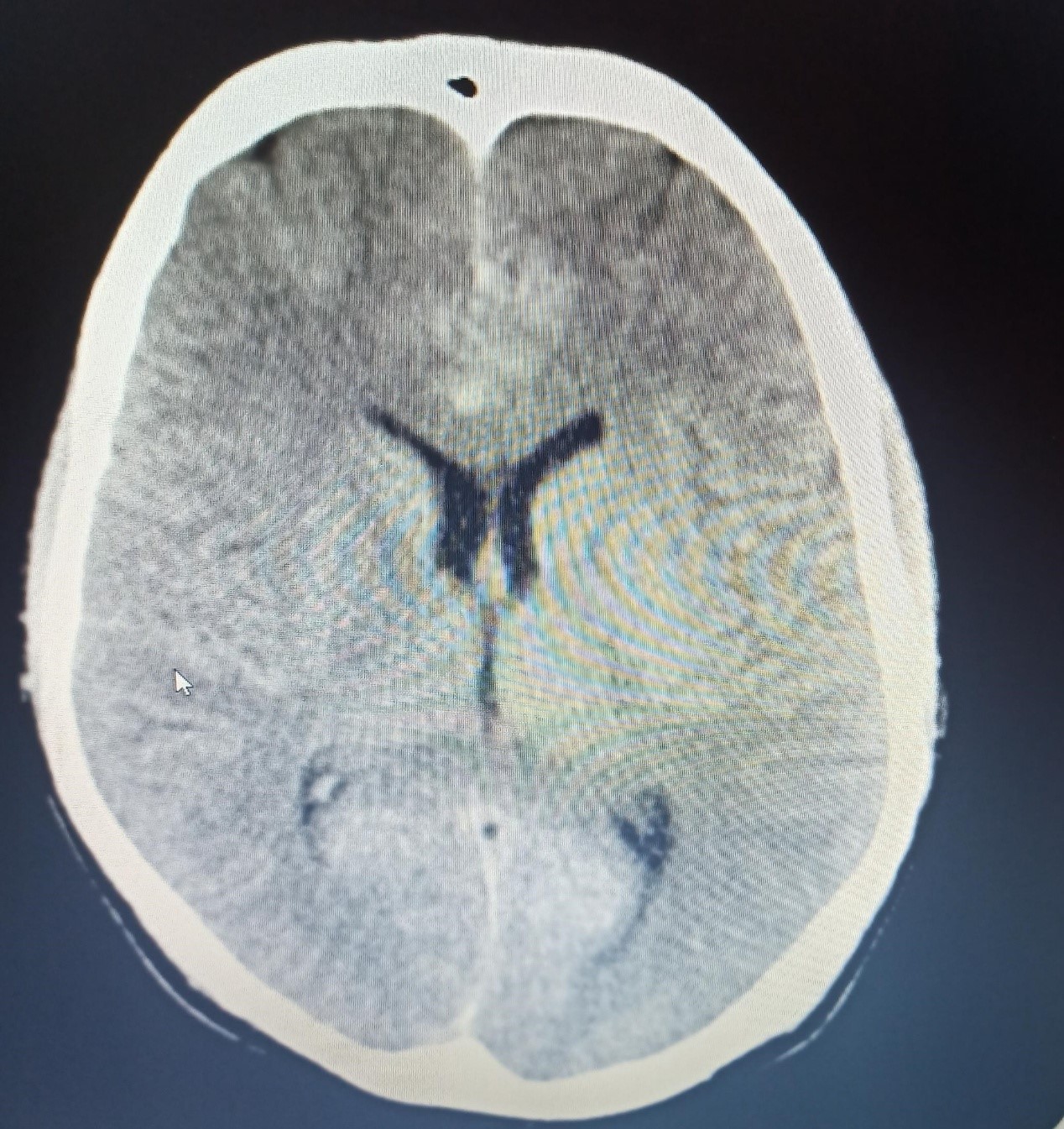 CT brain image gallery - SAH