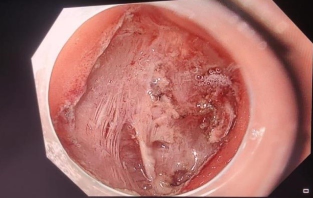 Endoscopic dissection from the base of the lesion