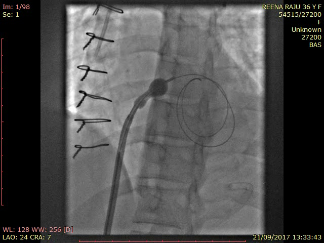 Balloon atrial septostomy (BAS) with 24 mm Inoue Balloon