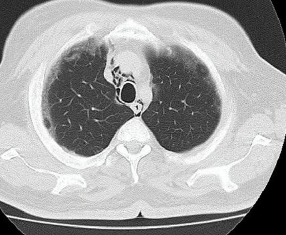 Spontaneous Pneumomediastinum