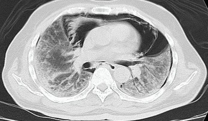 Spontaneous Pneumomediastinum