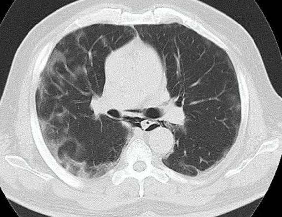 Spontaneous Pneumomediastinum