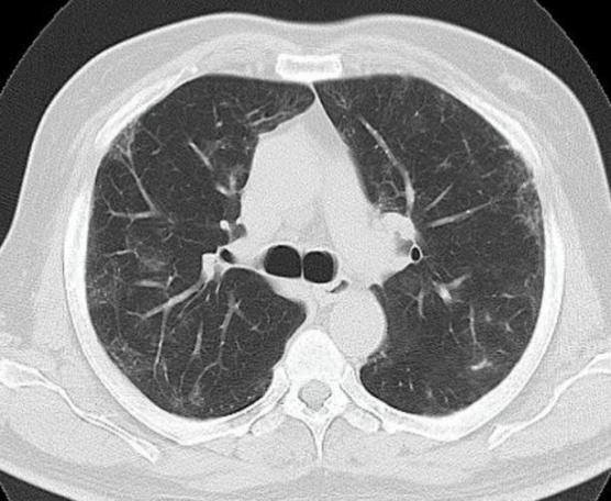Spontaneous Pneumomediastinum
