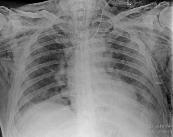 Spontaneous Pneumomediastinum