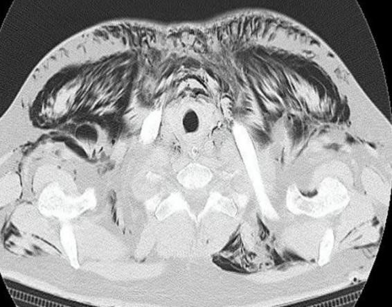 Spontaneous Pneumomediastinum