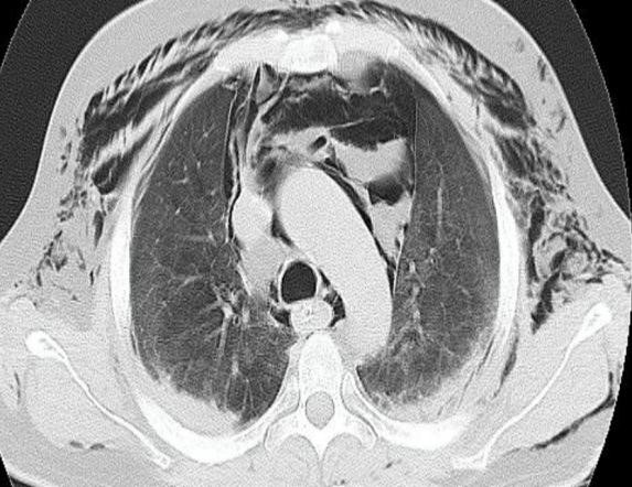 Spontaneous Pneumomediastinum