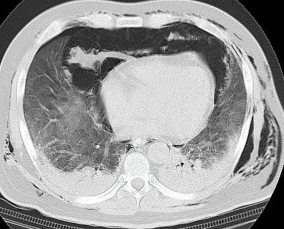 Spontaneous Pneumomediastinum