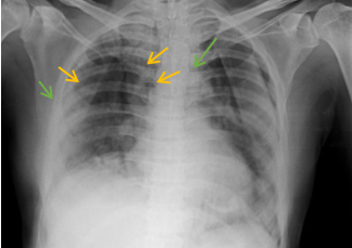 Spontaneous Pneumomediastinum