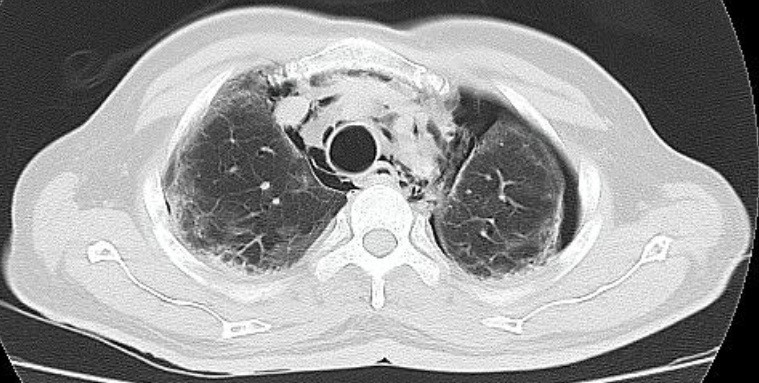 Spontaneous Pneumomediastinum
