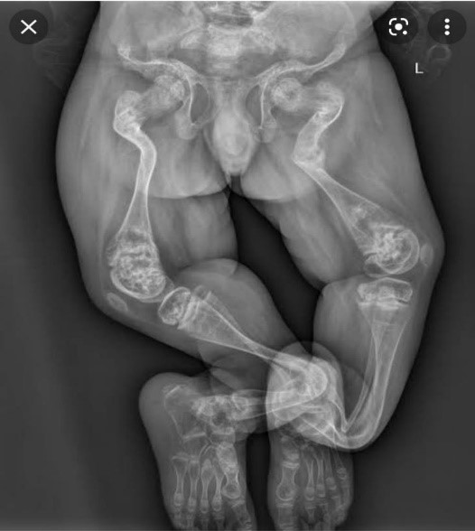 Osteogenesis imperfecta