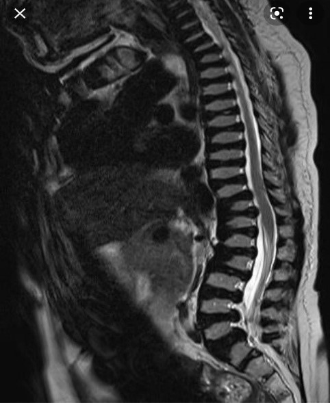 Morquio syndrome