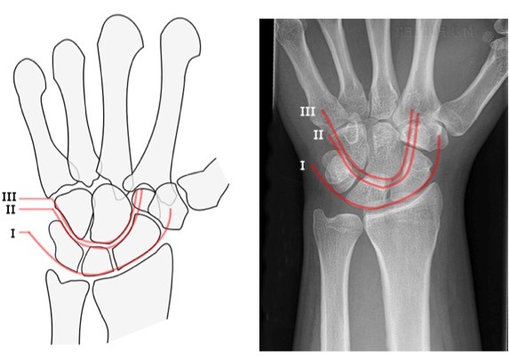 Carpometacarpal-dislocation-7