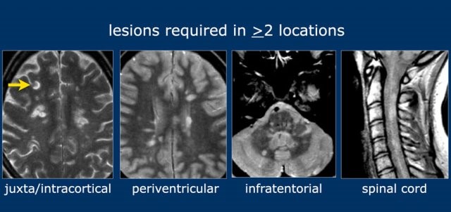 Multiple-Sclerosis-1