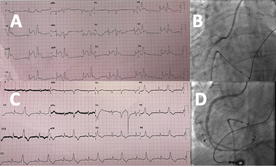 Radio-frequency ablation as an effective treatment strategy in a case of VT storm post STEMI
