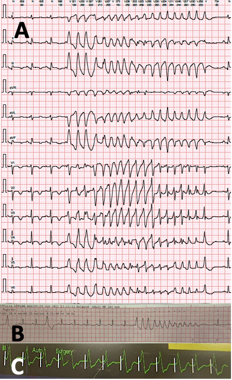 Radio-frequency ablation as an effective treatment strategy in a case of VT storm post STEMI