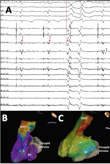 Radio-frequency ablation as an effective treatment strategy in a case of VT storm post STEMI