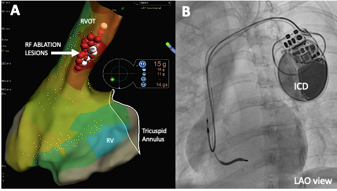 Radio-frequency ablation as an effective treatment strategy in a case of VT storm post STEMI