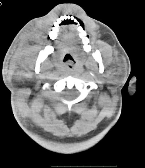 Angioedema-2