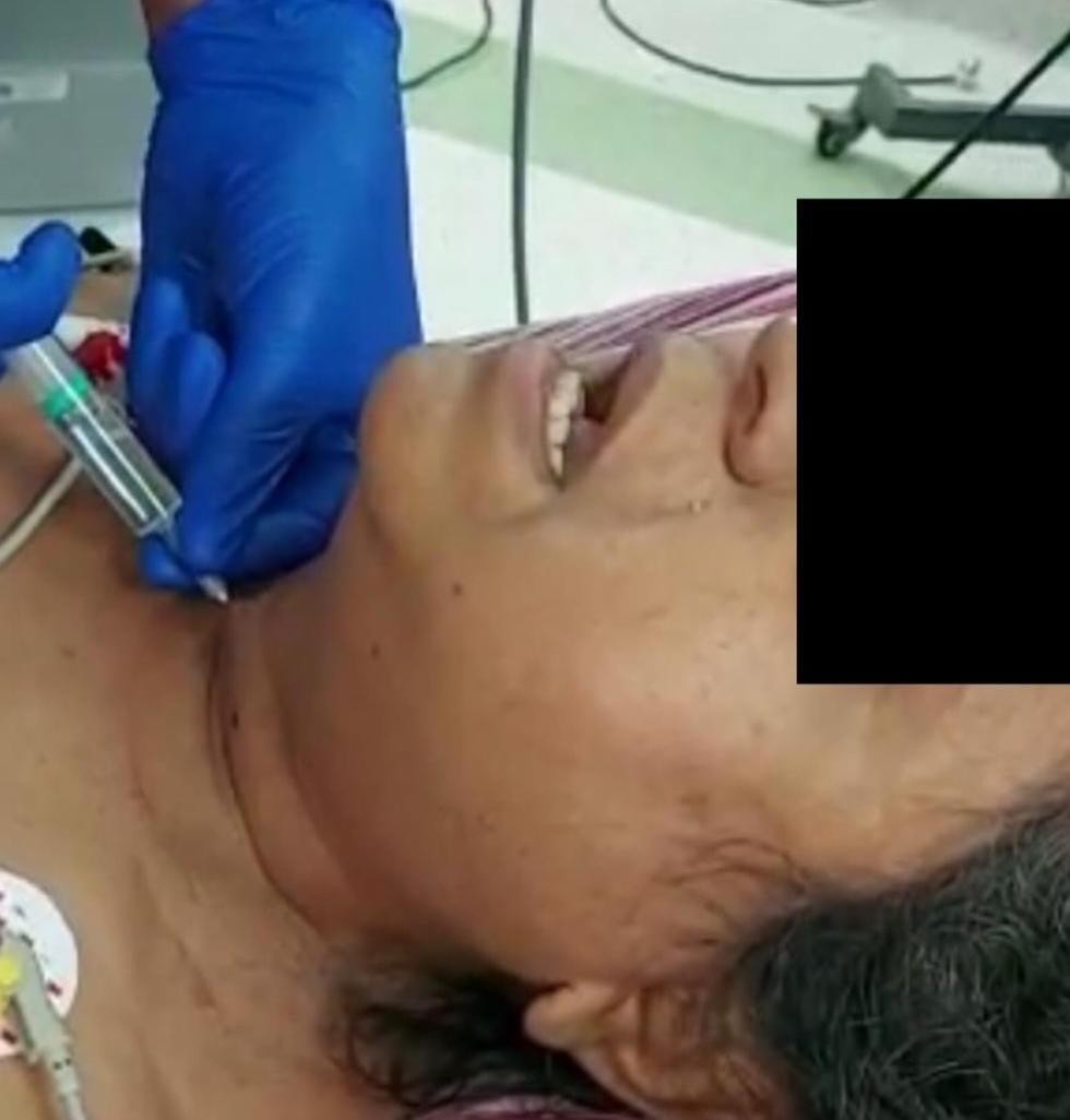 Parapharyngeal-abscess-3