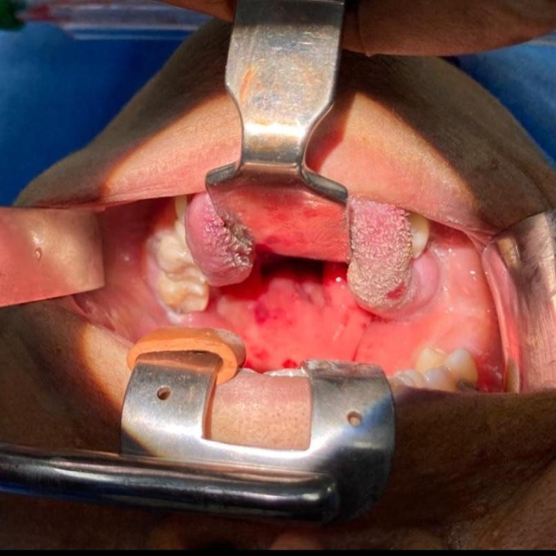 Parapharyngeal-abscess-4