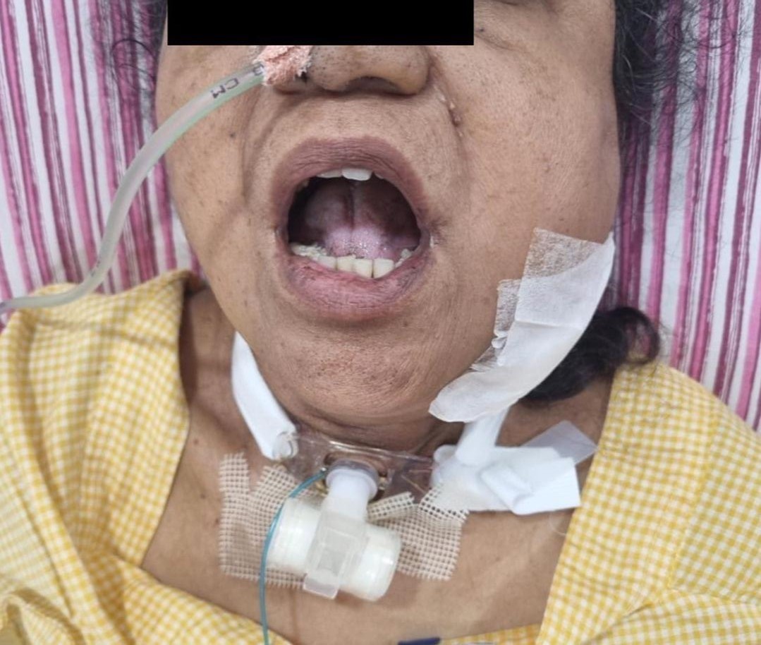 Parapharyngeal-abscess-5