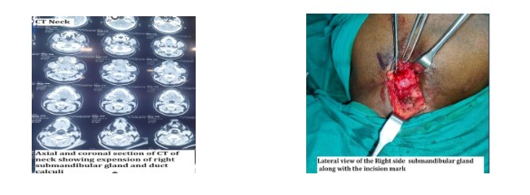 Sialadenitis-1