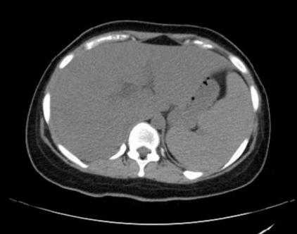 gross-pulmonary-edema-1