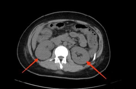 gross-pulmonary-edema-2