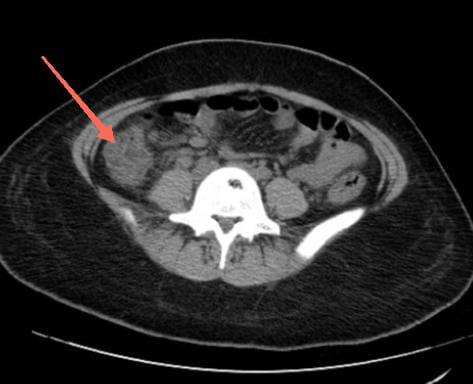 gross-pulmonary-edema-3