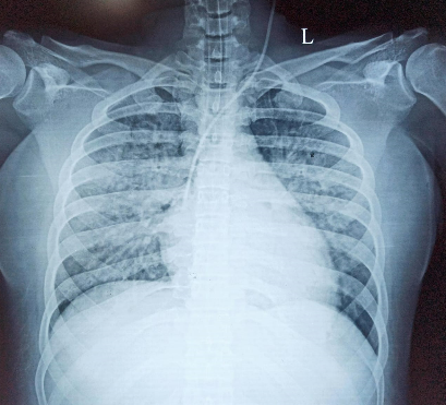 pulmonary-edema-3